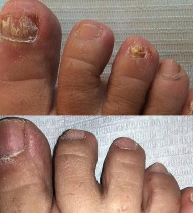 ToenailsPlus™ TRATAMIENTO PARA TODO TIPO DE HONGOS EN UÑAS Y PIEL PAGA 1 LLEVA 2