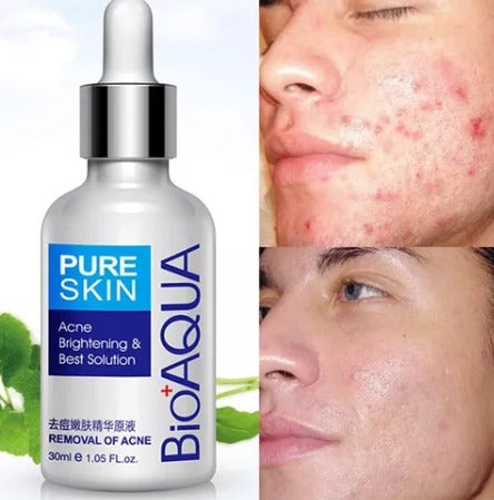 SerumⓇ Bioaqua NATURAL Elimina CICATRICES- Puntos Negros y HUNDIMIENTOS POST ACNE PAGA 1 LLEVA 2