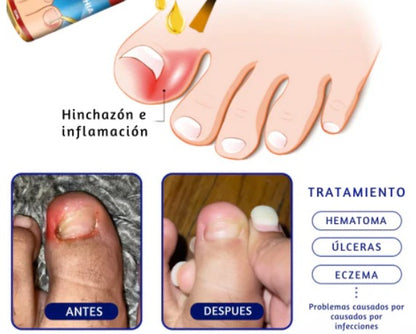 ToenailsPlus™ TRATAMIENTO PARA TODO TIPO DE HONGOS EN UÑAS Y CUERPO